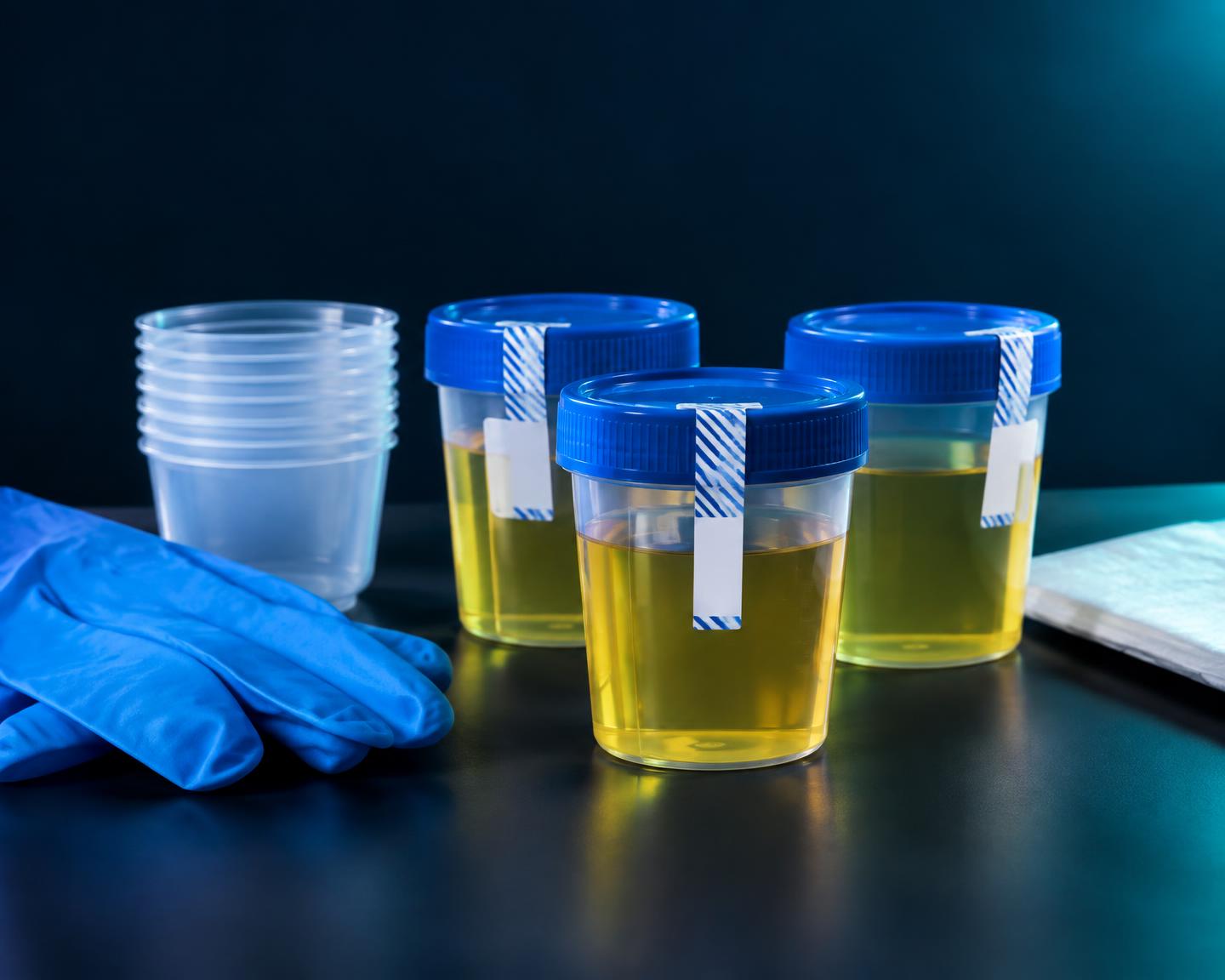 Sealed urine specimen containers with collection supplies